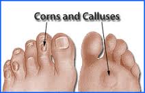 CORN and CALLUSES